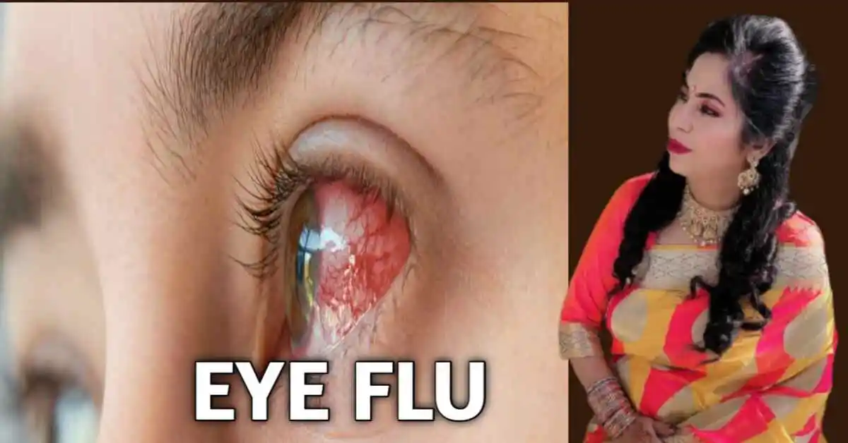 Eye Flu के Symptoms कारण Eye Flu Treatment In Hindi